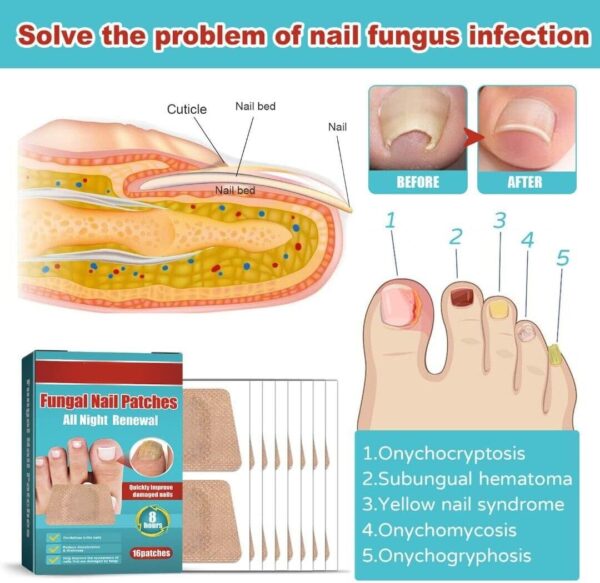 16 Parches Tratamiento Hongos en las uñas