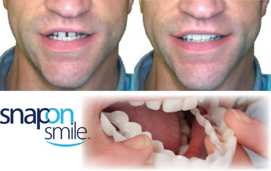 Carillas snap on smile dientes