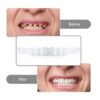 Carillas snap on smile dientes