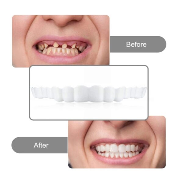 Carillas snap on smile dientes